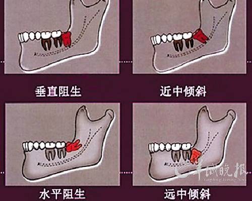 拔智齿平安福保险可以报销吗 拔智齿商业保险可以报销吗