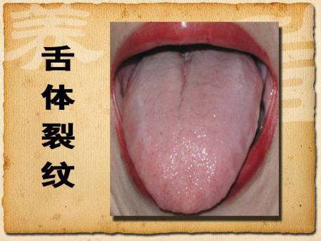裂纹舌地图舌并存图片