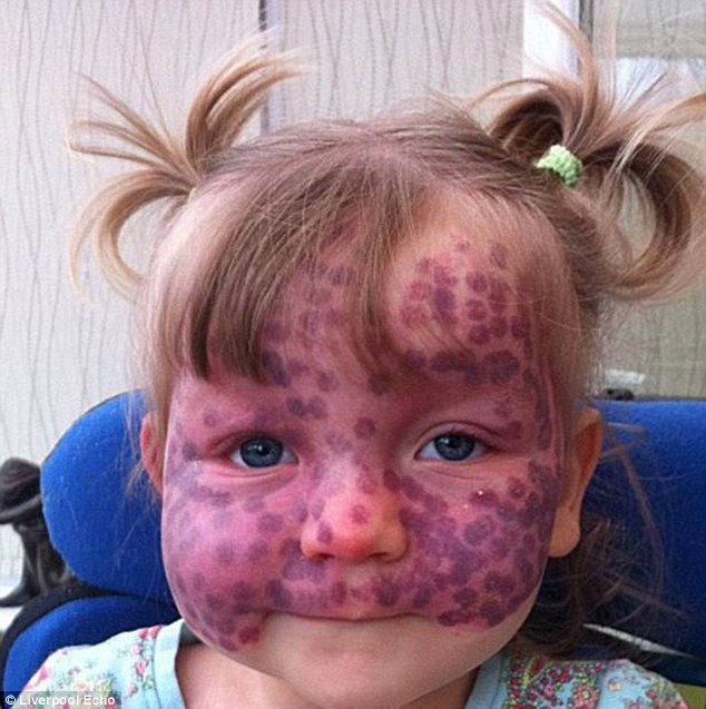孩子脸上血管瘤图片图片