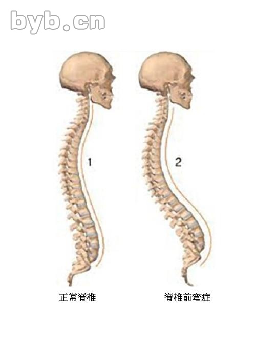 人体脊柱侧面曲线图片