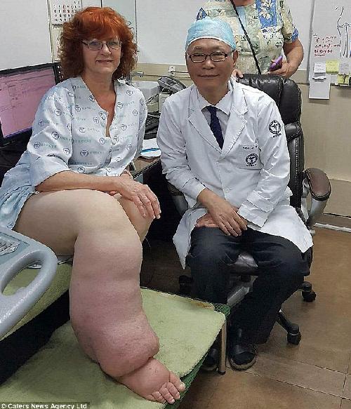 女子淋巴系統障礙右腿如象腿