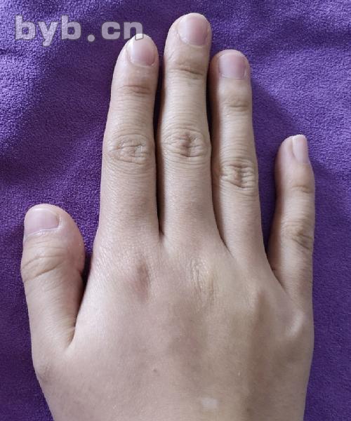 大拇指短甲症图片