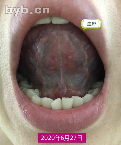 舌底青筋 正常图片图片
