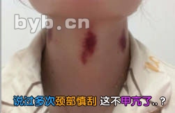 说过多次颈部慎刮 这不甲亢了..