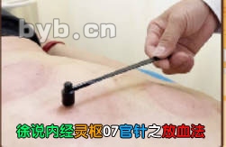 徐说内经灵枢07官针之放血法